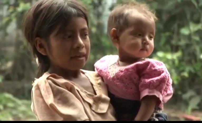 Preocupación por casos de desnutrición en Guatemala imagen